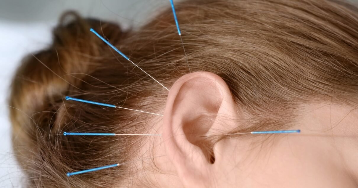 Tratamento de acupuntura para cessação tabágica e redução do craving em Lisboa Acupuncture treatment for smoking cessation and craving reduction in Lisbon