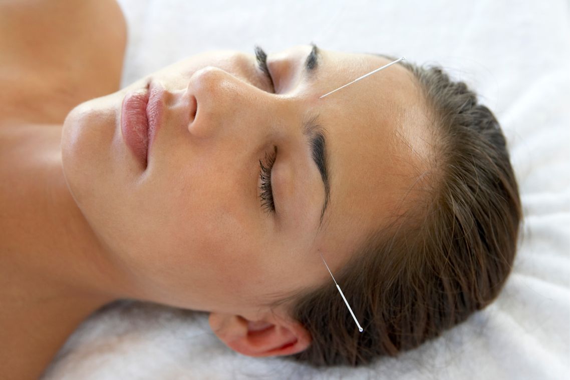 Tratamento de acupuntura para enxaqueca