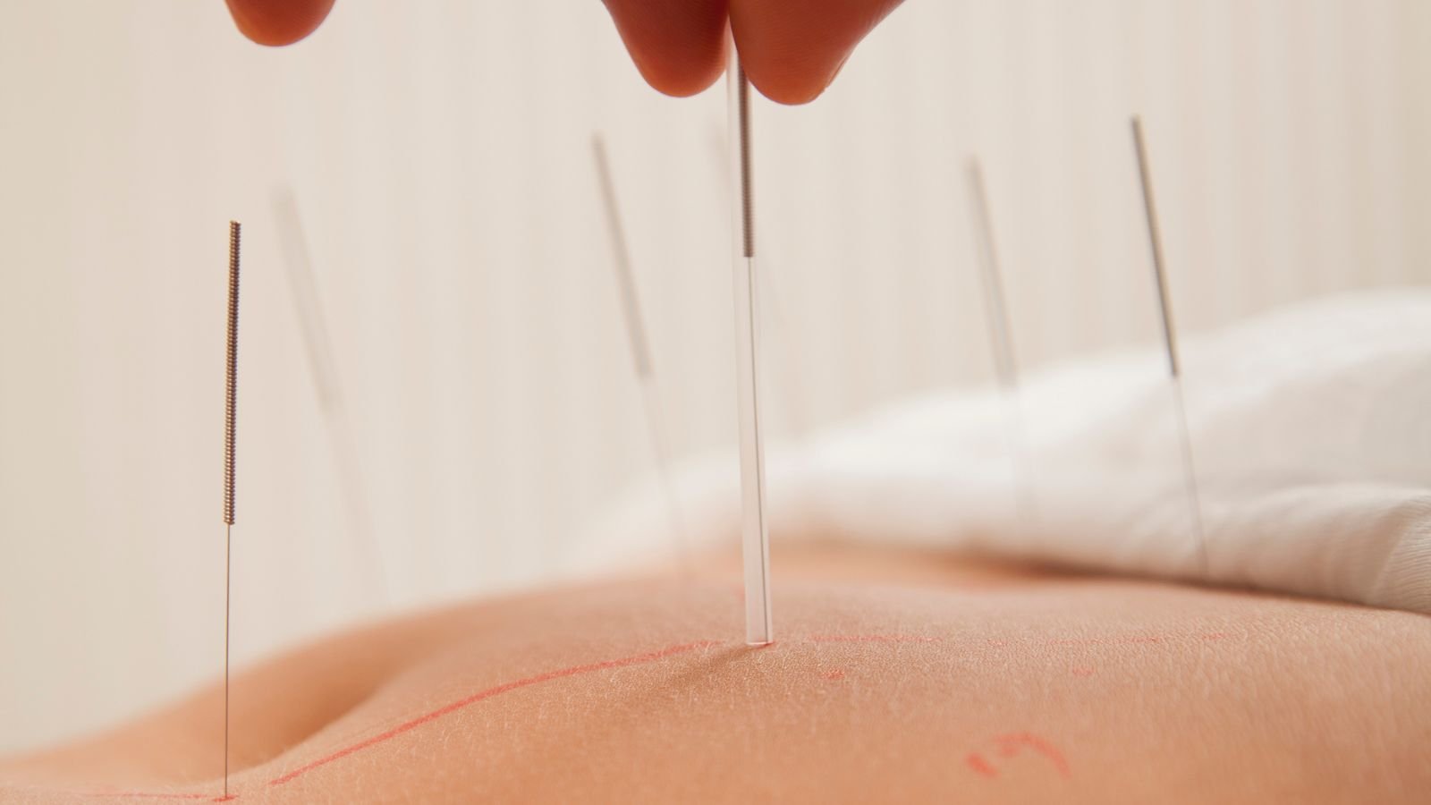 Acupuntura para fertilidade — detalhe clínico | Five Clinic Detalhe de agulhas de acupuntura em sessão de fertilidade — Five Clinic Lisboa